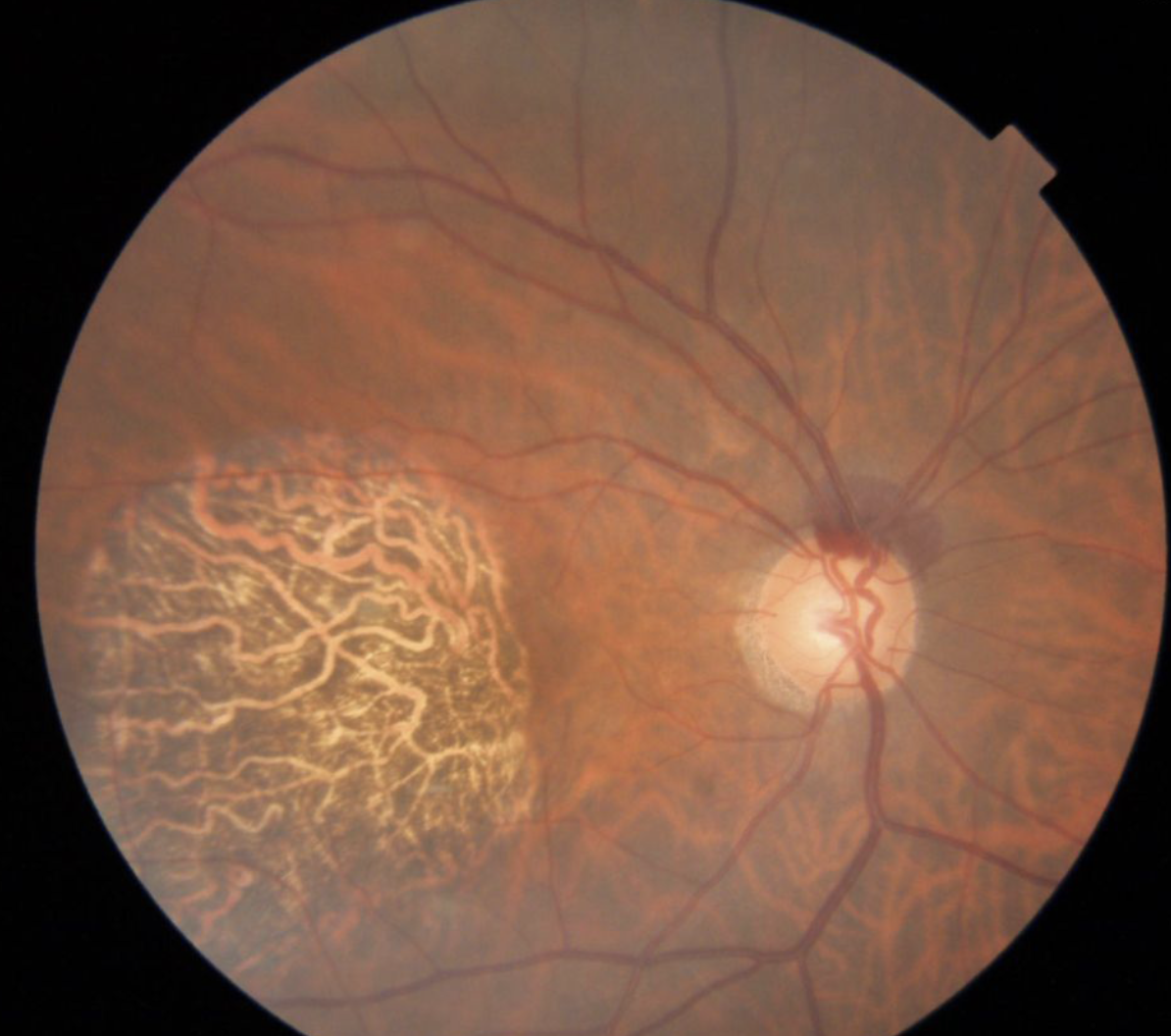 optic-disc-hemorrhage-what-next